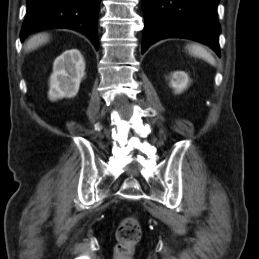File:Colon cancer with duodenal invasion (Radiopaedia 16278-15958 B 46).jpg