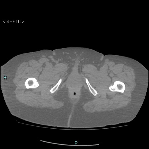 File:Colonic lipomas (Radiopaedia 49137-54244 Axial bone window 229).jpg