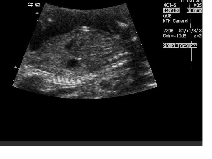 File:Congenital diaphragmatic hernia (Radiopaedia 16398).jpg