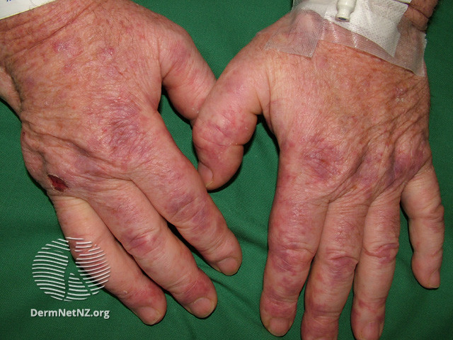 File:Cryoglobulinaemia (DermNet NZ vascular-cryoglob2).jpg