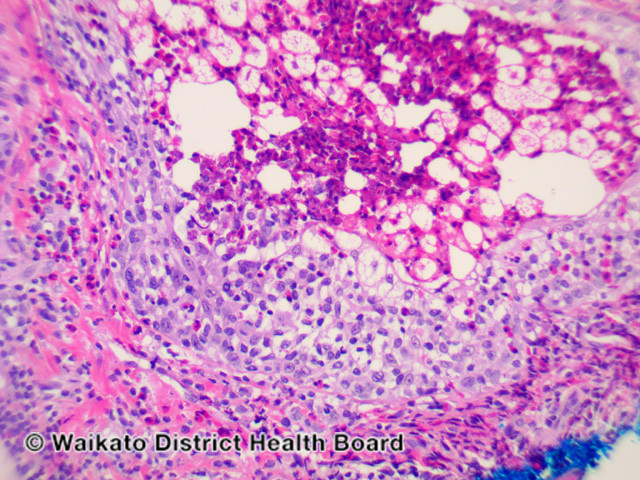 File:Figure 3 (DermNet NZ pathology-w-eosinophilic-folliculitis-fig-3).jpg