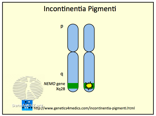 File:Incontinentia pigmenti (DermNet NZ Incontinentia-pigmenti).png