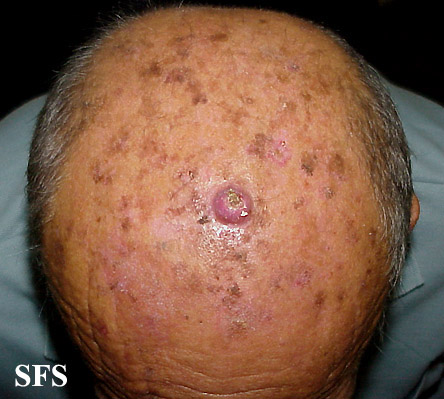 File:Keratoacanthoma (Dermatology Atlas 38).jpg