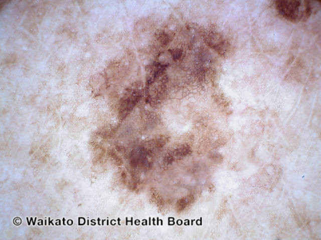 File:Melanoma in situ, nonpolarised dermoscopy view (DermNet NZ 225159).jpg