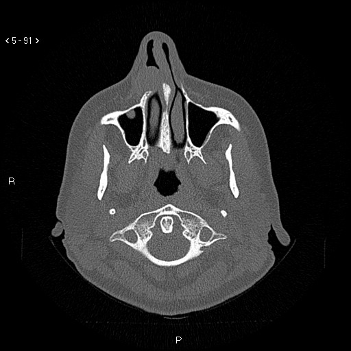 Nasolabial cyst (Radiopaedia 75125-86194 Axial bone window 52).jpg