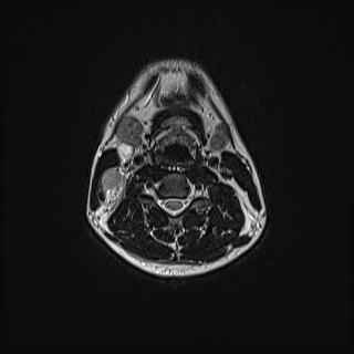 Nasopharyngeal carcinoma with perineural spread (Radiopaedia 55030-61380 Axial T2 55).jpg