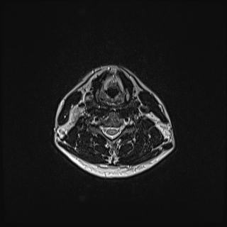 Nasopharyngeal carcinoma with perineural spread (Radiopaedia 55030-61380 Axial T2 60).jpg