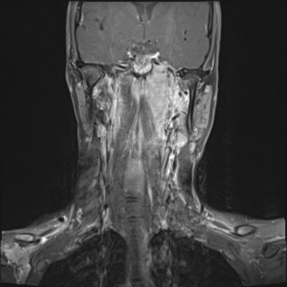 Nasopharyngeal carcinoma with skull base invasion (Radiopaedia 53415-59485 E 17).jpg