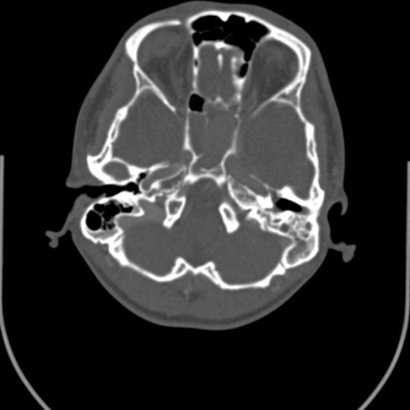 File:Nasopharyngeal carcinoma with skull base invasion (Radiopaedia 53415-59705 Axial bone window 15).jpg