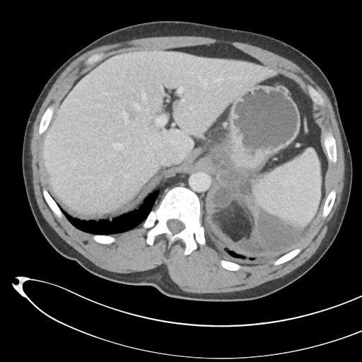 File:Necrotizing pancreatitis with acute necrotic collections (Radiopaedia 38829-41012 B 19).png