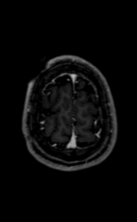 Neuro-Behçet disease (Radiopaedia 90112-107294 Axial T1 C+ 62).jpg