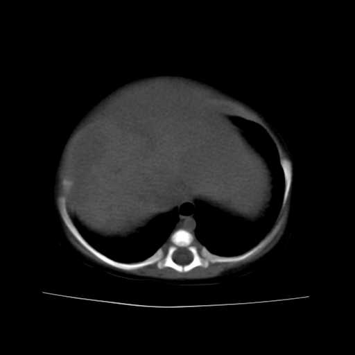 File:Neuroblastoma (Radiopaedia 20876-20799 Axial non-contrast 4).jpg