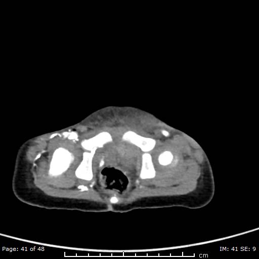 File:Neuroblastoma (Radiopaedia 41472-44355 A 41).jpg