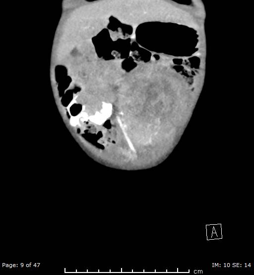 File:Neuroblastoma (Radiopaedia 41472-44355 B 9).jpg