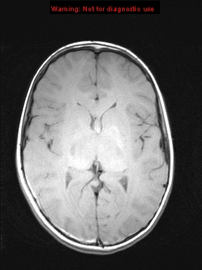 File:Neurofibromatosis type 1 with optic nerve glioma (Radiopaedia 16288-15965 Axial T1 12).jpg