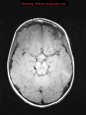 File:Neurofibromatosis type 1 with optic nerve glioma (Radiopaedia 16288-15965 Axial T1 15).jpg