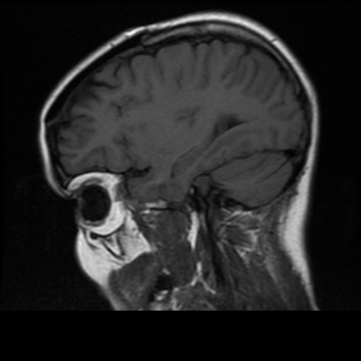 File:Neurofibromatosis type 2 (Radiopaedia 45229-49244 Sagittal T1 15).png