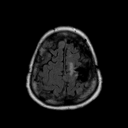 File:Neurofibromatosis type 2 (Radiopaedia 8713-9518 Axial FLAIR 4).jpg