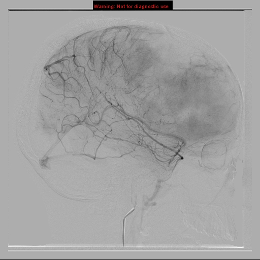 File:Neurofibromatosis type 2 (Radiopaedia 8953-9733 C 15).jpg