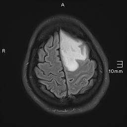 File:Neurotoxoplasmosis - concentric target sign (Radiopaedia 70644-80784 Axial FLAIR 18).jpg