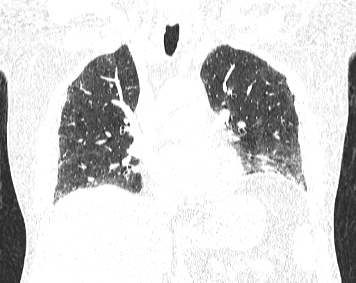 Non-specific interstitial pneumonia (NSIP) (Radiopaedia 68599-78228 Coronal lung window 43).jpg