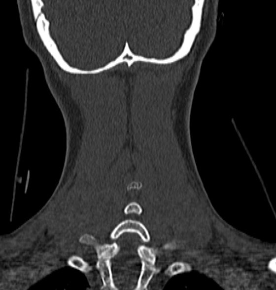 File:Normal CT cervical spine - 12-year-old (Radiopaedia 55352-61775 Coronal bone window 196).jpg