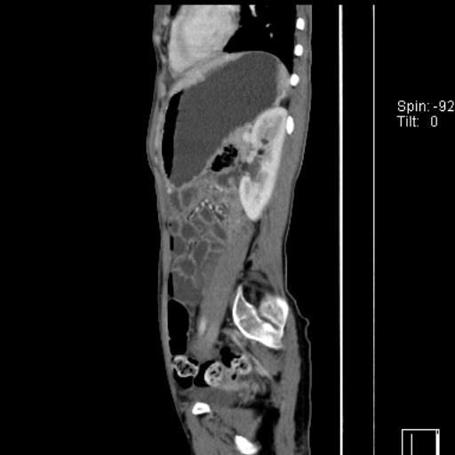 Normal CT enterography (Radiopaedia 30357-31000 D 16).jpg