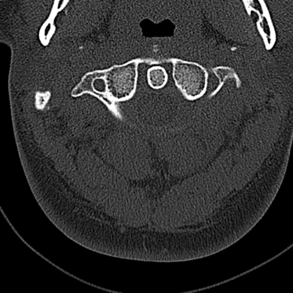 Normal CT of the cervical spine (Radiopaedia 53322-59305 Axial bone window 64).jpg