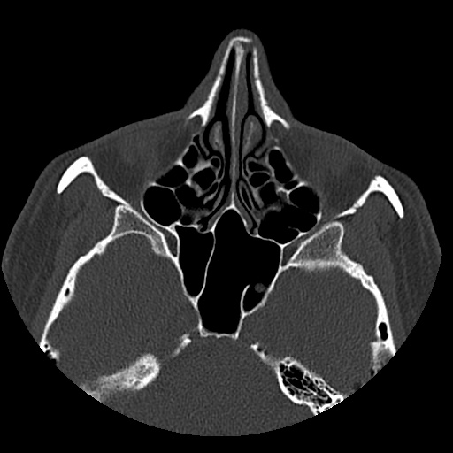 Normal CT paranasal sinuses (Radiopaedia 42286-45390 Axial bone window 57).jpg