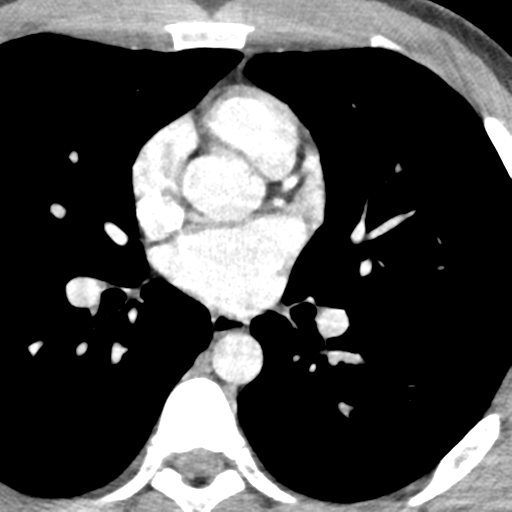 File:Normal CT pulmonary veins (pre RF ablation) (Radiopaedia 41748-44702 A 131).png