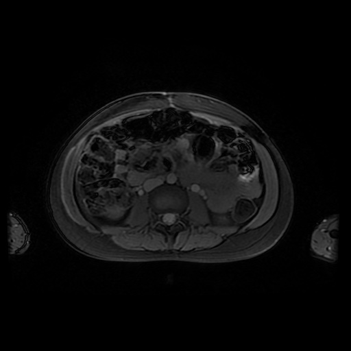 File:Normal MRI abdomen in pregnancy (Radiopaedia 88001-104541 D 28).jpg