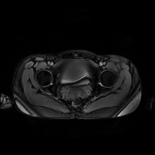 File:Normal MRI abdomen in pregnancy (Radiopaedia 88001-104541 D 53).jpg