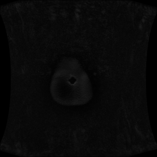 Normal MRI abdomen in pregnancy (Radiopaedia 88001-104541 M 9).jpg