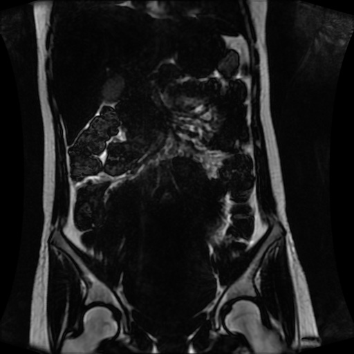 Normal MRI abdomen in pregnancy (Radiopaedia 88001-104541 N 67).jpg