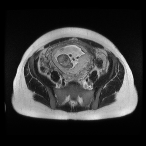 Normal MRI abdomen in pregnancy (Radiopaedia 88003-104546 Axial T2 33).jpg
