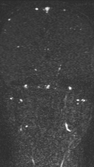 Normal MRI brain with MRV- teenager (Radiopaedia 49425-54553 Coronal MRV 137).jpg