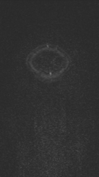 Normal MRI brain with MRV- teenager (Radiopaedia 49425-54553 Coronal MRV 32).jpg