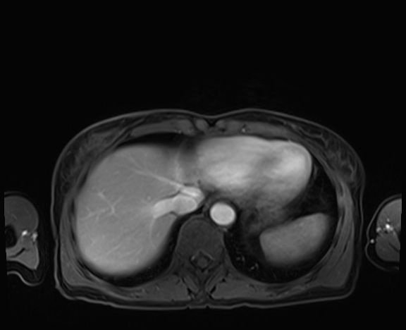 Normal adrenal glands MRI (Radiopaedia 82017-96004 K 11).jpg
