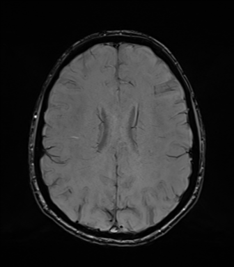 Normal brain MRI (TLE protocol) (Radiopaedia 40748-43405 Axial SWI 56).png