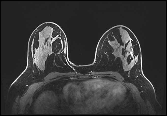 Normal breast MRI - dense breasts (Radiopaedia 80454-93850 C 108).jpg