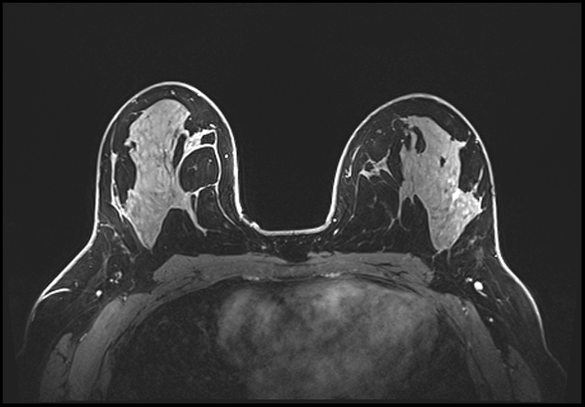 Normal breast MRI - dense breasts (Radiopaedia 80454-93850 C 119).jpg