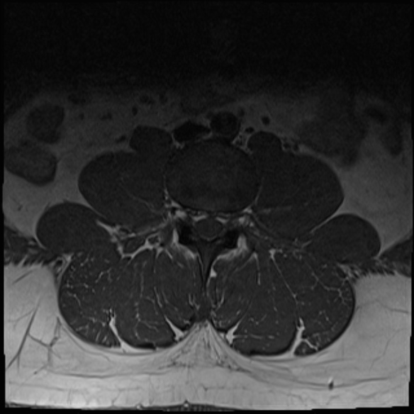 File:Normal lumbar spine MRI (Radiopaedia 47857-52609 Axial T1 5).jpg
