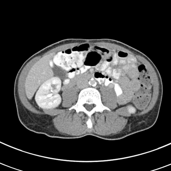File:Normal multiphase CT liver (Radiopaedia 38026-39996 C 47).jpg