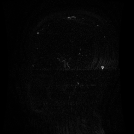 Normal noncontrast MR venography (Radiopaedia 87578-103957 A 100).jpg