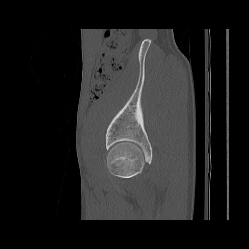 Normal pelvis (Radiopaedia 51473-57238 Sagittal bone window 34).jpg