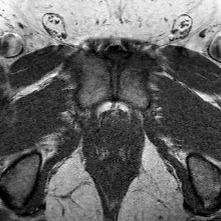File:Normal prostate (MRI) (Radiopaedia 29986-30535 Axial T1 2).jpg