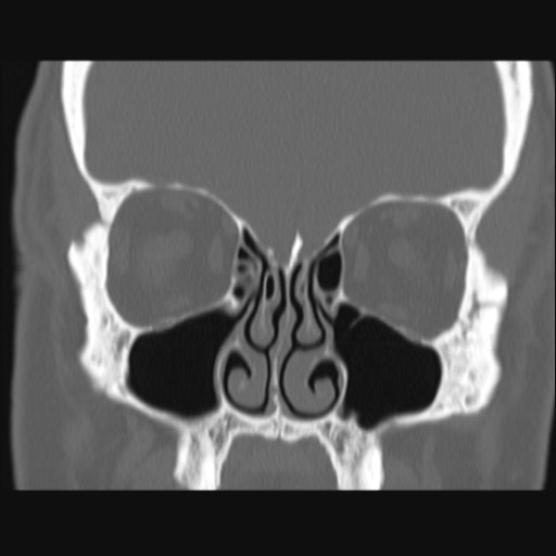 Normal sinus CT (annotated) (Radiopaedia 78917-91810 Coronal bone window 26).jpg