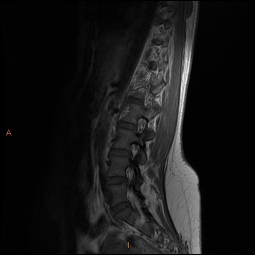 File:Normal spine MRI (Radiopaedia 77323-89408 Sagittal T1 10).jpg