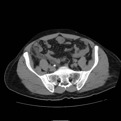 File:Obstructed kidney with perinephric urinoma (Radiopaedia 26889-27066 Axial non-contrast 50).jpg