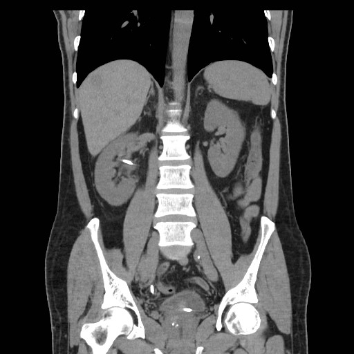 File:Obstructed kidney with perinephric urinoma (Radiopaedia 26889-27067 Coronal non-contrast 13).jpg